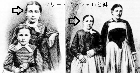 甲状腺切除後悪液質の患者、マリー・ビッシェルと妹 甲状腺切除後悪液質の患者、マリー・ビッシェルと妹